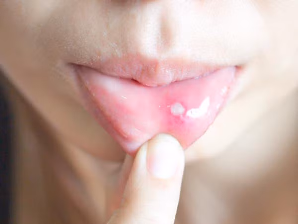 5 tác hại không ngờ khi uống quá nhiều nước chanh ảnh 4
