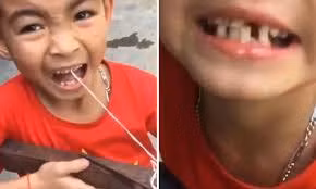 Clip cậu bé Việt Nam nhổ răng bằng nỏ lên báo Anh