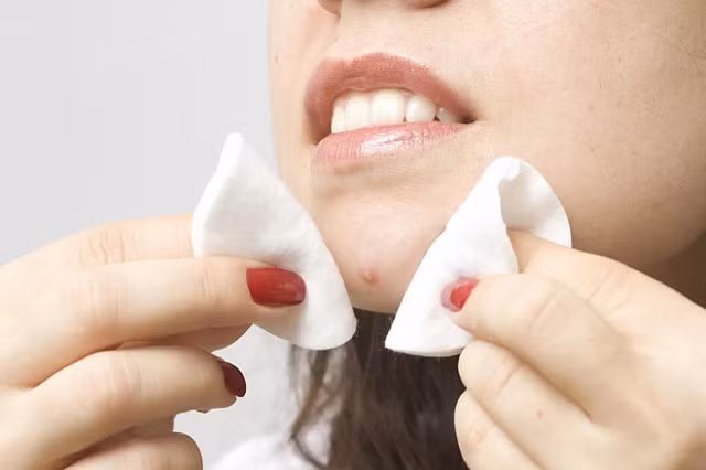 Lưu ý ngay những điều sau để việc nặn mụn không gây ra những hậu quả nghiêm trọng - Hình 7
