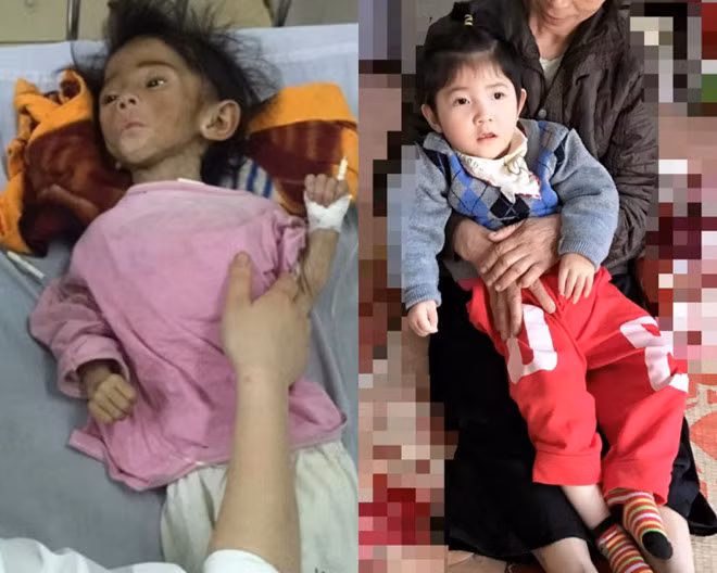 Em bé Lào Cai gầy gò, ốm yếu ngày nào giờ thay da đổi thịt nhờ sự chăm sóc của mẹ nuôi. 9X nhan nuoi be bai nao o Lao Cai: Nhin con rot nuoc mat khong nhan ra hinh anh 1