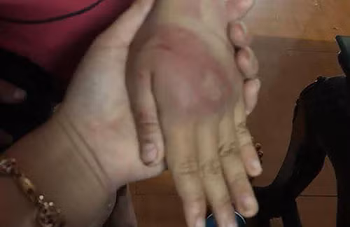 Không chỉ vùng mông, trên mặt và tay bé gái cũng đầy lằn roi. Ảnh: Lam Sơn. Không chỉ vùng mông, trên mặt và tay bé gái cũng đầy lằn roi. Ảnh: Lam Sơn.