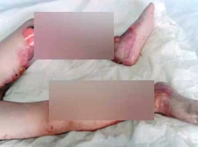 Mẹ tử vong, con gái bị bỏng nặng hai chân khi vừa cắm điện quạt máy