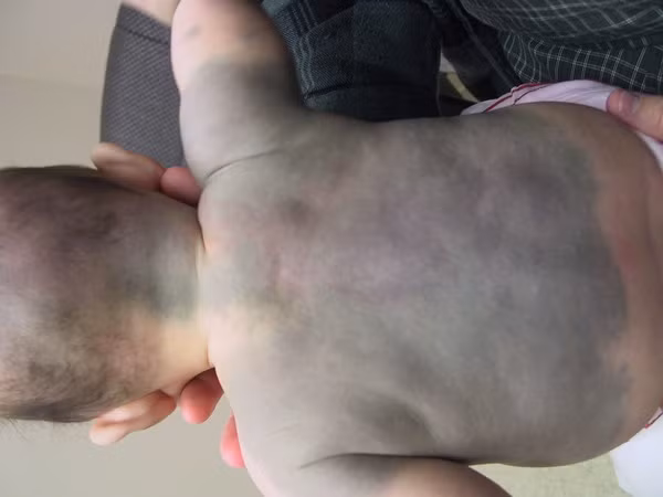 Mẹ trẻ lo lắng vì con mới sinh có nhiều vết BỚT XANH trên người và mặt