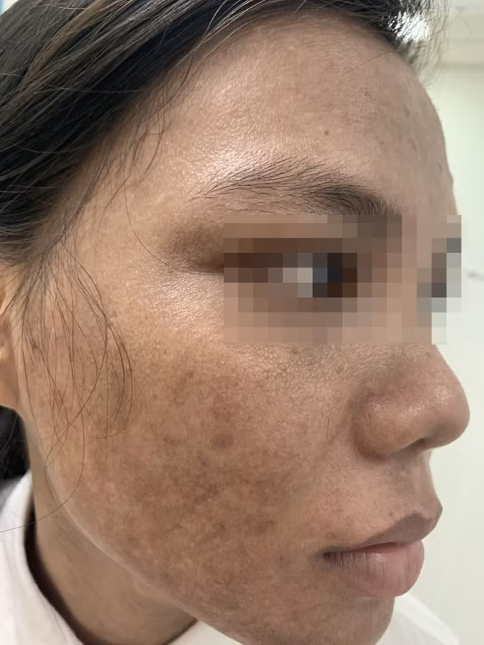 Kem trộn rao trên mạng tàn phá dung nhan một cô gái - Ảnh 1. Kem trộn rao trên mạng tàn phá dung nhan một cô gái - Ảnh 1.