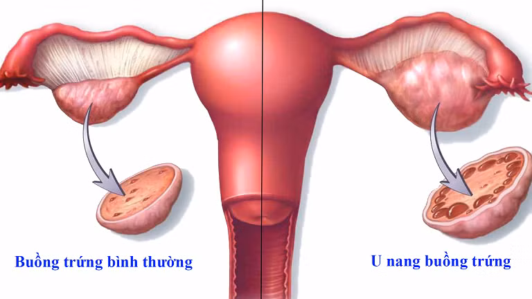 U nang buồng trứng thường gặp hơn ở nữ giới trong độ tuổi sinh sản.