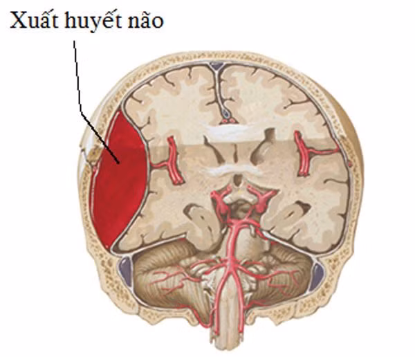 Không rượu bia, thuốc lá, kỹ sư 48 tuổi bất ngờ xuất huyết não do tham công tiếc việc - Ảnh 2.
