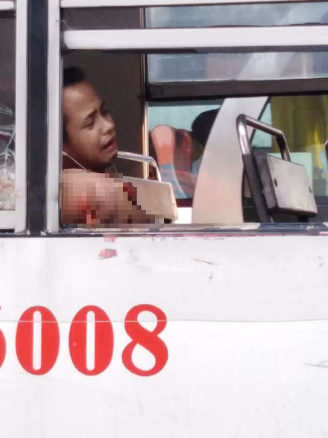 Thanh niên đau đớn mất cánh tay chỉ vì thói quen nhiều người mắc phải khi đi xe buýt ảnh 1