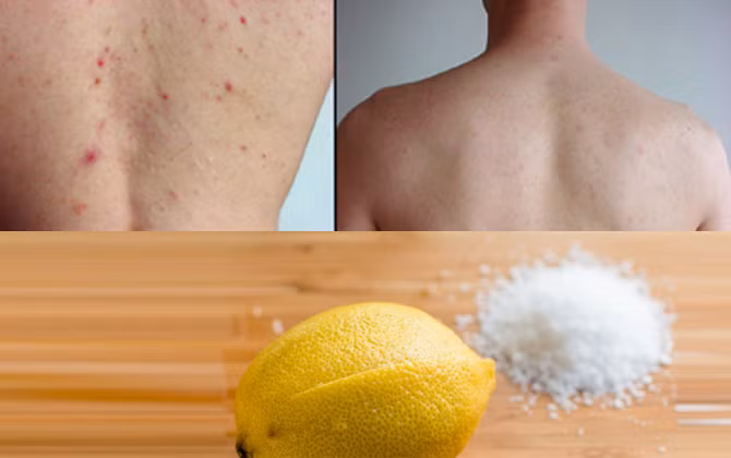 Cách trị mụn trứng cá ở lưng, ngực đơn giản và hiệu quả nhất