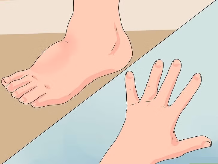 Tình trạng phù bạch huyết này cũng dễ xảy ở những người bị béo phì, mắc bệnh ung thư. 