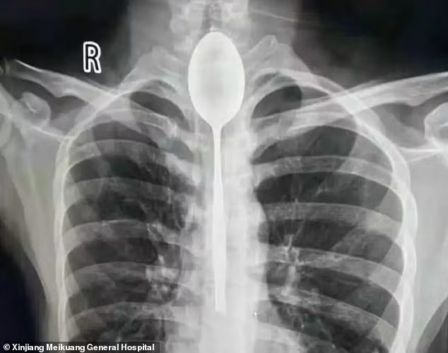 Hình ảnh chiếc thìa kim loại 20 cm nằm trong cơ thể bệnh nhân. Ảnh: Daily Mail