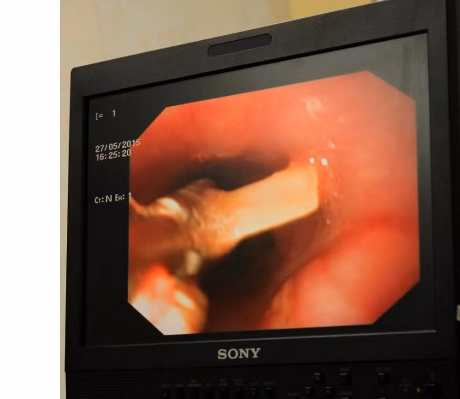 Mảnh xương cắm vào thực quản bệnh nhân