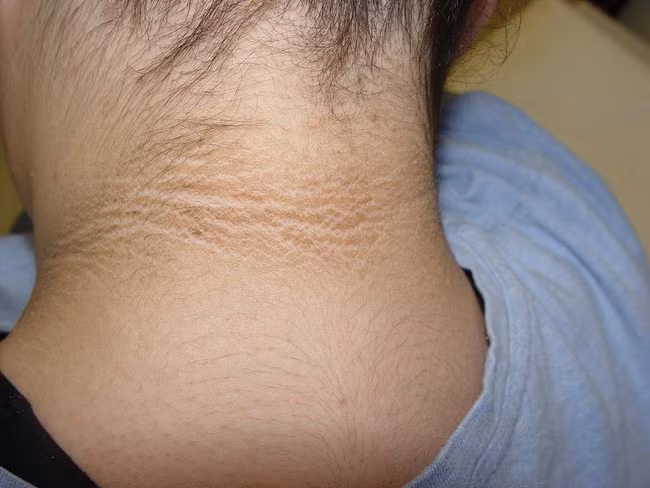 Cô bé 14 tuổi phát hiện mình mắc bệnh tiểu đường nhờ một dấu hiệu lạ ở quanh vùng cổ-2
