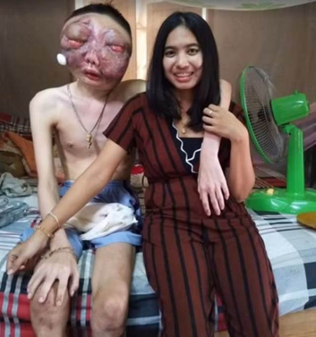 Khuôn mặt bạn trai mọc đầy u đến biến dạng, cô gái Thái vẫn yêu ảnh 1 Atittaya chụp ảnh bên cạnh bạn trai Pooh