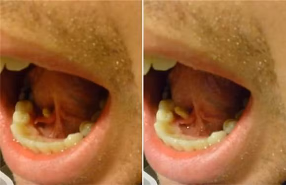 Chảy mủ, bị cộm dưới lưỡi, chàng trai nổi hết da gà khi ép được vật thể lạ này ra khỏi miệng 