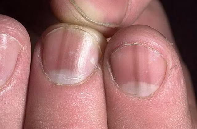 Nhìn dấu hiệu ở móng tay, biết ngay bạn đang mắc bệnh gì ảnh 1