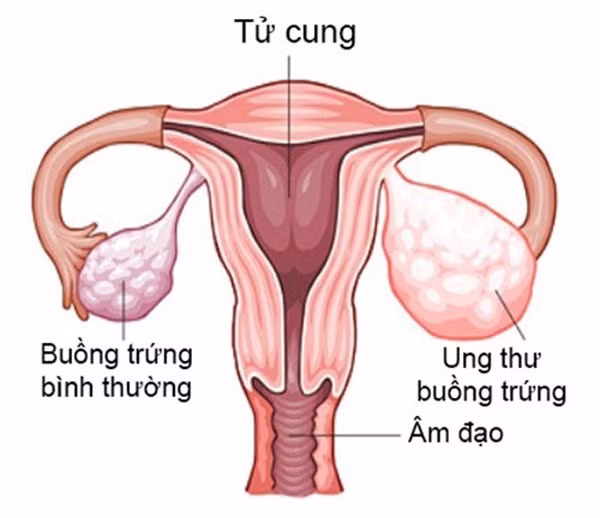 6 dấu hiệu cảnh báo bệnh ung thư buồng trứng, chị em cần lưu ý - 1
