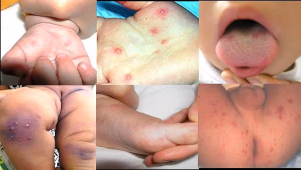 Những việc cha mẹ nào cũng nên làm để phòng bệnh tay chân miệng cho con-3