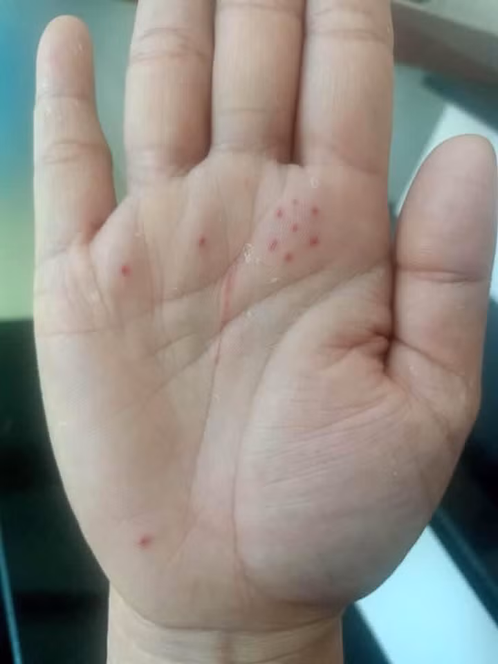 Thẩm mỹ tạo nốt ruồi son trên lòng bàn tay mong giàu sang phú quý, hậu vận tốt.