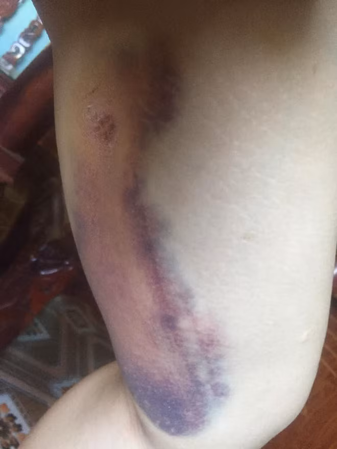 Sự thật bất ngờ gương mặt chằng chịt vết thương của Phượng “Thị Nở tái sinh“ ảnh 5 Bị đồn gương mặt biến dạng sau 2 năm PTTM, Thị Nở tái sinh lên tiếng giải thích lí do khiến ai nấy đều ngã ngửa