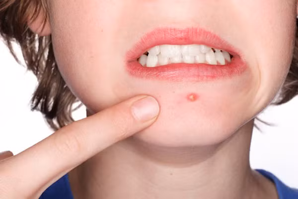 6 dấu hiệu cho thấy bạn không ăn đủ lượng rau củ quả cần thiết ảnh 2 Mụn trứng cá xuất hiện ở trán, cằm là dấu hiệu cảnh báo cơ thể đang thiếu chất xơ.