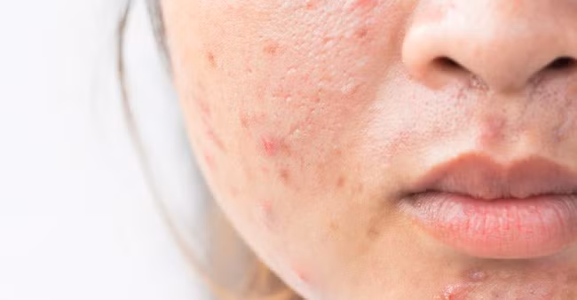 Đây chính là 4 viễn cảnh kinh hoàng xảy đến với làn da nếu bạn chỉ tẩy trang qua loa, đại khái - Ảnh 2.