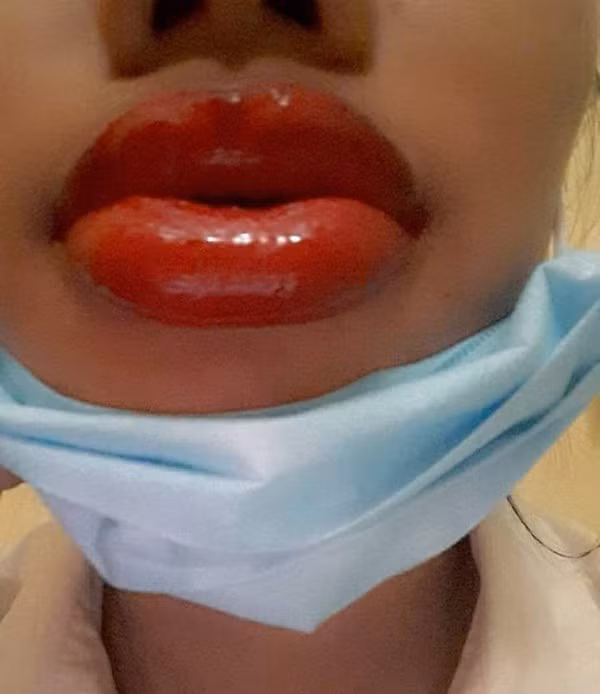 Đi xăm môi làm đẹp, cô gái không dám ra đường vì môi sưng tều như 2 cây xúc xích ảnh 5 Trông rất đáng sợ