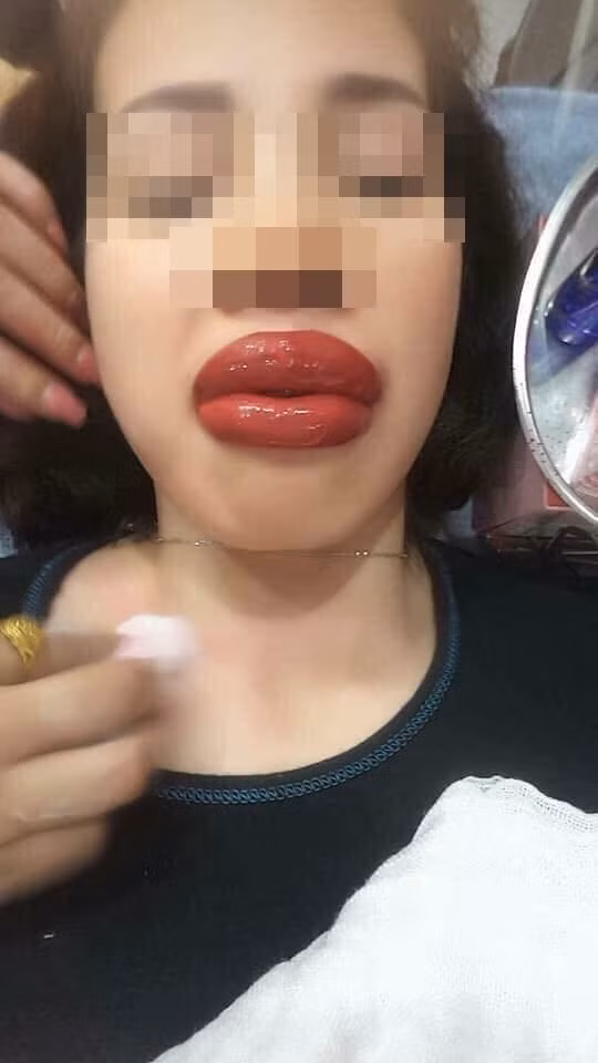 Đi xăm môi làm đẹp, cô gái không dám ra đường vì môi sưng tều như 2 cây xúc xích ảnh 1 Đôi môi sưng tều khiến nhiều người cảm thông nhưng vẫn không thể nhịn cười.