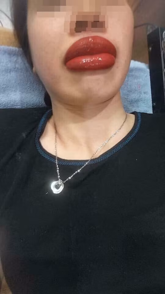 Đi xăm môi làm đẹp, cô gái không dám ra đường vì môi sưng tều như 2 cây xúc xích ảnh 2 Với đôi môi này, chắc chẳng cô gái nào tự tin bước ra đường.