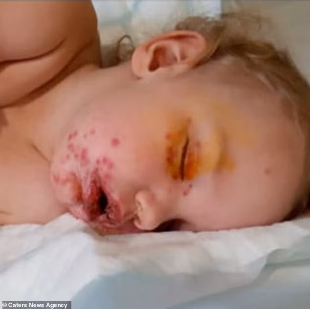 Bé trai nhiễm khuẩn herpes do “nụ hôn tử thần“ ảnh 1