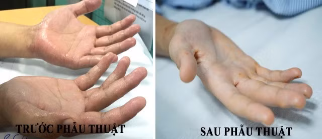 Bàn tay trước và sau phẫu thuật. (BVCC).