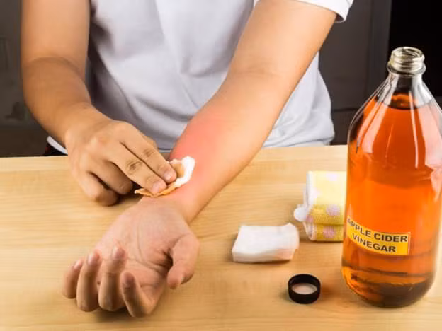Dấm có thể trị được triệu chứng bỏng rát (hình minh họa).