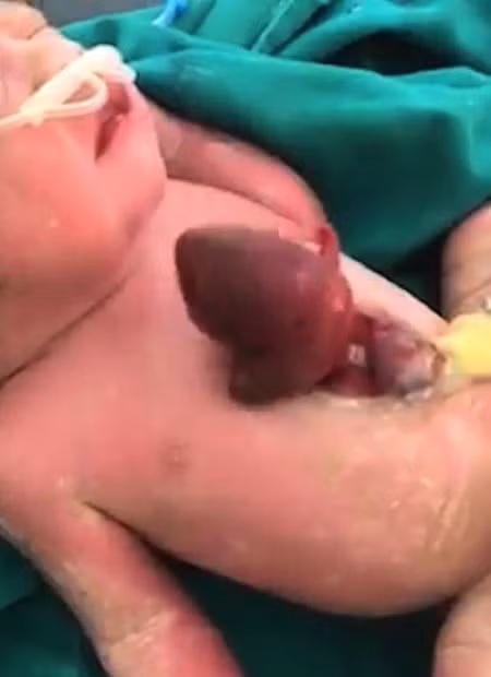 Trái tim của bé Little Maria Gloria Almeida nằm ngoài lồng ngực