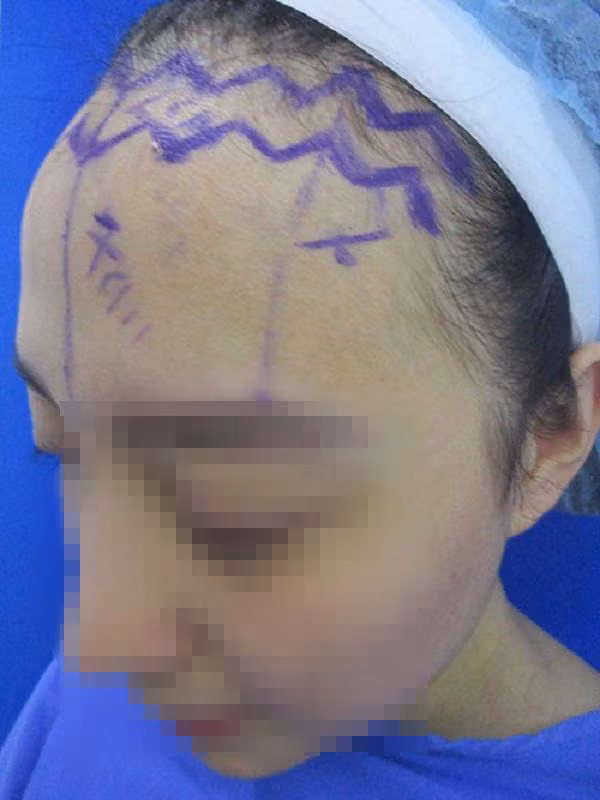 Sửa mũi cắt môi “xưa rồi”, chị em bây giờ rủ nhau làm đẹp kinh dị thế này ảnh 2 Sửa mũi cắt môi đã là gì, chị em bây giờ còn rủ nhau đi cắt da đầu để...-2