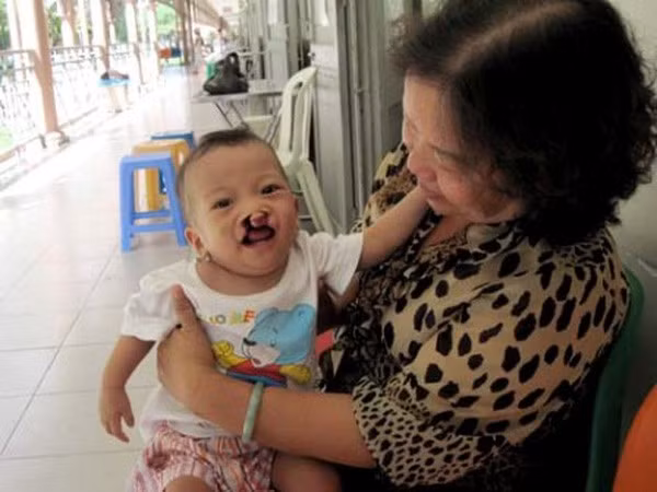 Tật sứt môi hàm ếch thường gặp ở trẻ chủ yếu do người mẹ thiếu a xít folic trước và trong thai kỳ