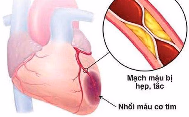 nguoi phu nu bi nhoi mau co tim, gan mat mang chi vi an nhieu thuc pham nay - 4