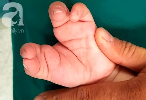 TP.HCM: Mẹ nghẹn ngào khi con trai 2 tuổi mắc hội chứng tôm hùm vô cùng hiếm gặp khiến tay chân dị dạng-1