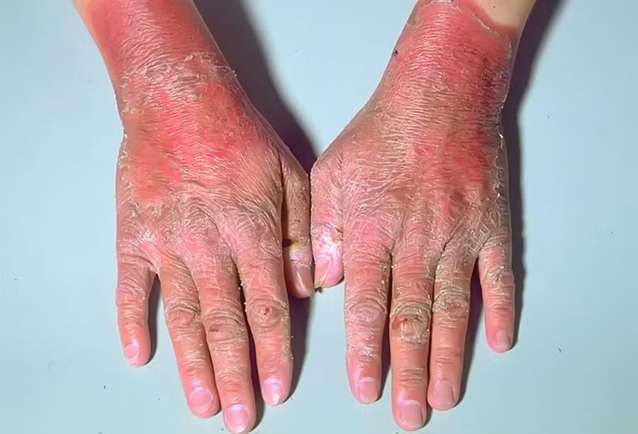 Bệnh viêm da pellagra, cần B3 để ngăn ngừa và chữa trị. Bệnh viêm da pellagra, cần B3 để ngăn ngừa và chữa trị.