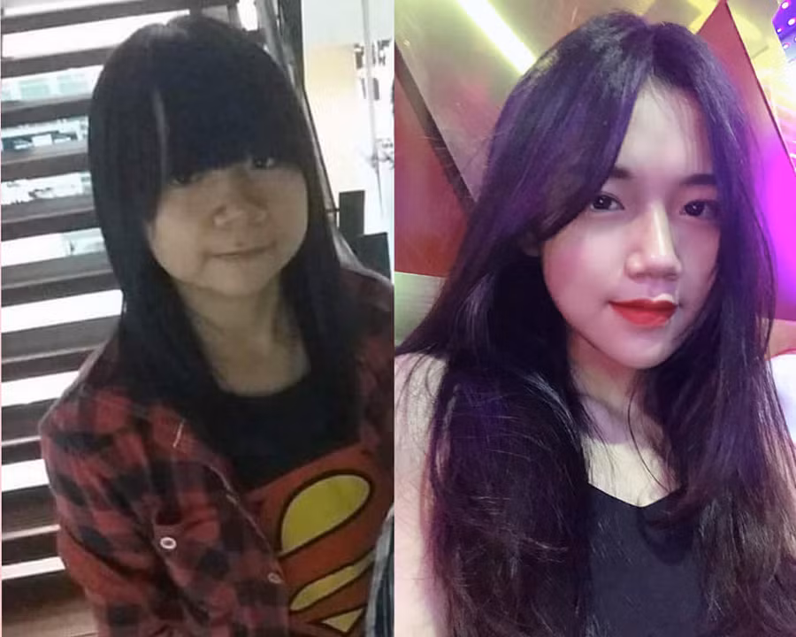 Bị bạn học trêu chọc là xấu xí, cô gái đợi đến 19 tuổi để phẫu thuật thẩm mỹ thành hot girl-9