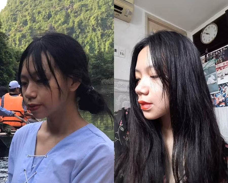 Bị bạn học trêu chọc là xấu xí, cô gái đợi đến 19 tuổi để phẫu thuật thẩm mỹ thành hot girl-6
