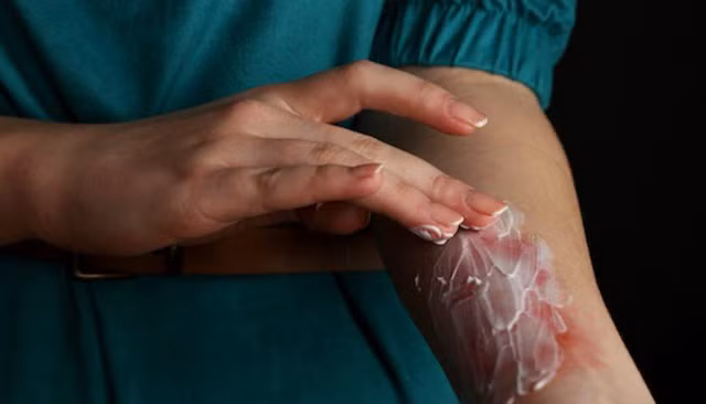 Thoa các dung dịch lạ lên vùng da bỏng có thể vết thương thêm trầm trọng hơn. Ảnh: Breath And Beats.
