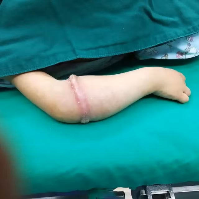 Da bé Le Le bị sưng đỏ lên