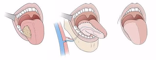 Nhiệt miệng mãi không khỏi, đi khám phải cắt 1/2 lưỡi: cách phân biệt ung thư và nhiệt miệng - 2