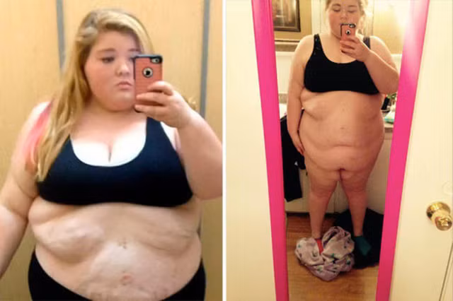 Nicola từng nặng tới 25,5 stone (gần 162 kg)