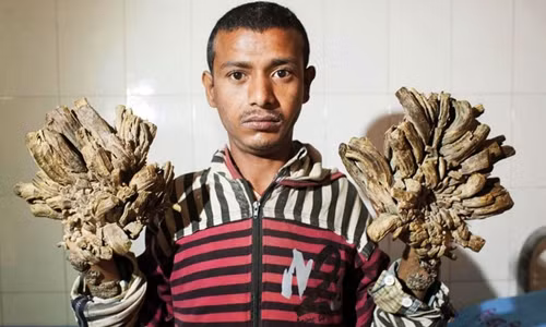 "Người cây" Bangladesh phải nhập viện vì căn bệnh tiến triển không ngờ ảnh 1 Abul Bajanda hồi tháng 1/2016. Ảnh: AFP.