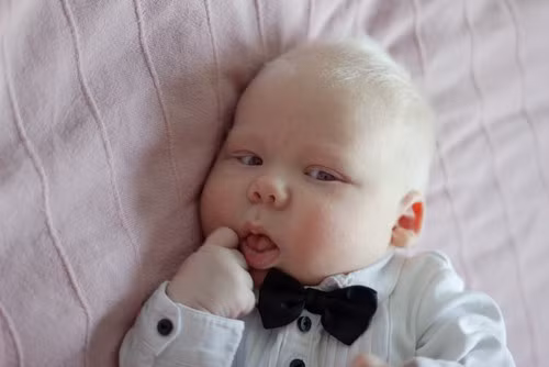 Bệnh nhân mắc bệnh bạch tạng toàn phần thường có da trắng bạch, tóc trắng, mắt đỏ.