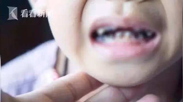 cau be 3 tuoi co toi 16 chiec rang bi mun nat, do thoi quen rat nhieu tre mac phai - 1