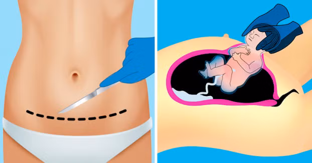 Mách mẹ 5 cách giúp vết mổ đẻ không đau, nhanh lành, không để lại sẹo