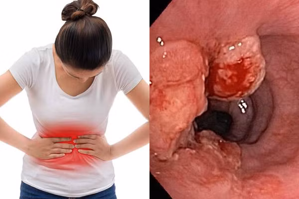 Đi khám vì đau bụng, thiếu nữ 16 tuổi phát hiện ung thư dạ dày di căn