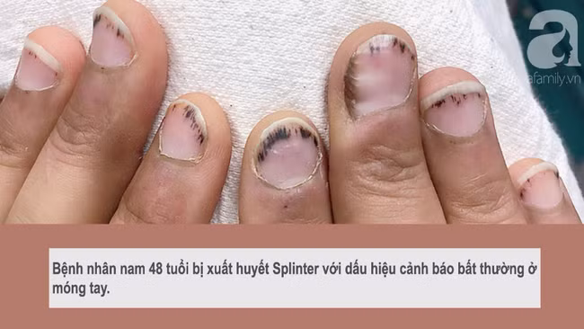 Dấu hiệu bất thường ở móng tay cảnh báo bệnh viêm van tim ít ai biết-1