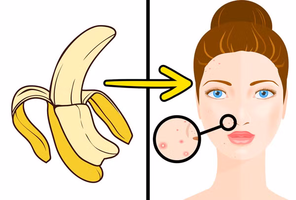 Trị mụn Vỏ chuối rất giàu vitamin C, E, kali, sắt và kẽm, các hợp chất có khả năng làm dịu làn da bị viêm, giảm mụn đỏ,
